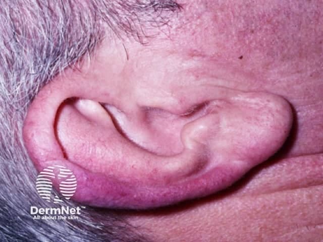 This is a high-resolution clinical photograph of a cutaneous lesion in the auricular region, captured in a lateral view of the external ear. The focal area is consistent with lupus pernio, the chronic, violaceous plaque-form of cutaneous sarcoidosis that commonly involves the nose, cheeks, ears, and lips, with the pinna often affected. The lesion appears as a well-defined, violaceous to reddish-purple plaque on the helix/pinna, with subtle surface sclerosis and mild edema; surrounding skin shows faint erythema without obvious ulceration. In cutaneous sarcoidosis, such plaques reflect dermal granulomatous infiltration; histology (if obtained) would typically show noncaseating granulomas composed of epithelioid histiocytes and Langhans-type giant cells, often with sparse lymphocytic rim. Clinically, lupus pernio is a marker of chronic sarcoidosis and may correlate with systemic involvement, including pulmonary, ocular, and cardiac disease; therefore, thorough evaluation (chest imaging, ACE levels, calcium metabolism, hepatic function) is recommended. Differential considerations include granulomatous rosacea, actinic granuloma, other granulomatous dermatitis, and infectious etiologies in the appropriate context. This image is valuable for dermatology education, sarcoidosis characterization, and monitoring therapeutic response to corticosteroids, immunomodulators, or biologic agents. This photographic depiction supports clinical diagnosis and aids multidisciplinary management decisions.