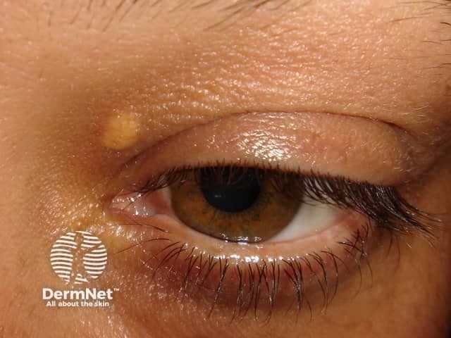This is a high-resolution clinical photograph of a periorbital eyelid lesion consistent with xanthelasma palpebrarum. Modality and technique: Clinical photography, color RGB, close-up macro of the left upper eyelid and medial canthus with frontal/oblique view to document lesion position and morphology. Anatomical localization: Periorbital skin around the left palpebral region; upper eyelid; medial canthus; integumentary system. Visual features: Soft, well-circumscribed, yellow to pale-orange plaque on the superior medial eyelid, with smooth surface and slight flattening at the margins. Coloration more pronounced toward the medial aspect; surrounding skin shows mild hyperpigmentation and normal folds. Pathologic inference: Xanthelasma represents lipid-laden macrophage infiltration in the dermis; visually appears as lipid-rich, cholesterol-laden deposits beneath the epidermis; while biopsy would show foamy histiocytes and cholesterol clefts. Diagnostic significance: Strong clinical cue for dyslipidemia; often associated with hyperlipidemia or inherited lipid disorders; warrants lipid profile evaluation and cardiovascular risk assessment. Clinical use: Educational for dermatology and ophthalmology trainees; differential includes syringomas, milia, sebaceous hyperplasia; radiology not applicable; management involves lipid control, laser or surgical removal for cosmetic reasons. Useful in teaching exam-style questions about diagnosis, morphology, differential, and systemic associations. This image anchors discussion of dermatologic signs correlating with systemic lipid disorders.