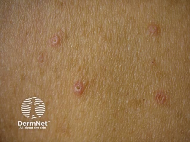 Clinical photography of cutaneous lesions showing multiple umbilicated papules consistent with molluscum contagiosum. The image presents a close-up, surface-view of pink to flesh-colored domed papules, approximately 2–4 mm in diameter, arranged in a multifocal cluster on exposed trunk skin. Each lesion displays a central dimple or crater-like indentation with a smooth, slightly shiny surface and no overt crusting or scale. The surrounding dermis appears non-inflamed, with fine skin texture and visible adnexal pores; mild hyperemia is not prominent. These features are characteristic of a benign poxvirus infection in which keratinocytes harbor intracytoplasmic molluscum bodies; histology would reveal eosinophilic cytoplasmic inclusions. Clinically this pattern supports molluscum contagiosum as a primary diagnosis, though verruca vulgaris or epidermal inclusion lesions can be included in the differential. The diagnostic significance lies in recognizing contagious cutaneous lesions that may self-resolve yet transmit infection, particularly in children or immunocompromised adults; management may involve observation, curettage, or topical ablative therapies. The image is useful for educational purposes, tele-dermatology triage, and pattern-recognition training, enabling learners to distinguish umbilicated papules from other papular eruptions. Potential clinical use cases include screening, diagnosis confirmation via biopsy/PCR if uncertain, and documenting treatment response.