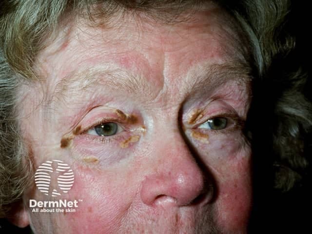 Imaging modality: Clinical photography. Frontal close-up view of the face focusing on the periorbital, malar and nasal regions. The patient is an elderly adult; skin shows diffuse facial erythema with pronounced redness across cheeks and nasal bridge. There are lichenified, crusted plaques along the upper and lower eyelids with yellow-brown crusts adherent to the lash margins. The periorbital skin exhibits mild edema and scale; surrounding skin is dry and sun-damaged. No obvious vesicles; no primary lesion on lips; the nose shows a slightly shiny, telangiectatic surface. The presentation is most consistent with inflammatory dermatitis involving the face, with periorbital blepharitis-like crusting. Differential diagnoses include seborrheic dermatitis (greasy scales, eyelid involvement), atopic dermatitis (lichenoid irritation), contact dermatitis to facial products, rosacea with centrofacial erythema, and psoriasis in the facial milieu. The image documents a chronic, possibly irritant-exposure driven dermatosis with eyelid involvement. Clinical significance includes the need to differentiate dermatitis from infectious etiologies and to guide topical therapy (emollients, mild topical steroids, calcineurin inhibitors) and eyelid hygiene. The image is valuable for education and research on facial dermatitis phenotypes, periorbital dermatitis, blepharitis-related crusting, and sun-damaged skin in elderly patients. High-resolution imaging supports telemedicine, documentation, and longitudinal assessment of treatment response outcomes.