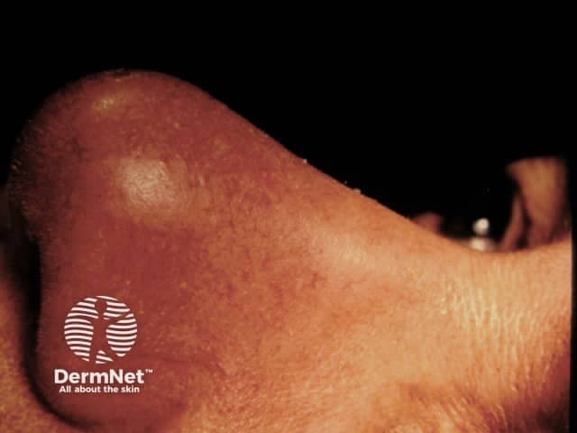 Clinical photography of a distal finger demonstrates lupus pernio, a cutaneous manifestation of sarcoidosis. This high-resolution close-up captures violaceous, indurated plaques and nodules along the dorsolateral aspect of a digit, with subtle erythema and a slightly shiny surface. The lesion is firm to palpation and demonstrates the characteristic chronic, non-ulcerating plaque morphology seen in cutaneous sarcoidosis. Anatomically, the lesion involves dermal and subcutaneous tissue of the finger pad and proximal phalanx region, consistent with acral sarcoid involvement. In the context of radiology dermatology correlation, lupus pernio often correlates with systemic sarcoidosis, including pulmonary, ocular, and cardiac involvement; thus this image has diagnostic significance beyond cosmetic appearance. Differential diagnoses include granulomatous rosacea, infectious granulomas, granulomatous dermatitis, and other inflammatory nodules; however, the violaceous hue, chronicity, and acral localization favor sarcoidosis. Clinically, recognition of lupus pernio prompts multidisciplinary assessment and potential immunosuppressive therapy. This image is useful for medical education, dermatology reference, and research in sarcoidosis phenotypes, disease activity monitoring, and treatment response evaluation. It can support case discussions on pathophysiology, imaging correlation, and prognostic implications in chronic sarcoid disease. This lesion's appearance reinforces the need for holistic evaluation to exclude systemic sarcoidosis and guide multidisciplinary management and care.