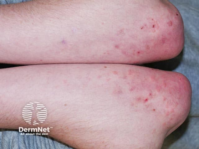 This high-resolution clinical photograph shows bilateral elbow skin with a pruritic vesiculopapular eruption typical of dermatitis herpetiformis. The extensor surfaces of both elbows display clustered vesicles and papules on a background of erythema, with adjacent crusting from scratching. Lesions are symmetrically distributed on the antecubital and olecranon regions, reflecting the classic DH predilection for extensor surfaces. The skin appears non-ulcerated, with variable edema and a mosaic of small vesicles that may be grouped in crops. In DermNet terms, the rash is intensely pruritic and may present as vesicles, papules, and urticarial plaques; this image captures the hallmark pattern without deep infection. Pathophysiology involves IgA immune complex deposition at dermal papillae, correlating with gluten sensitivity and potential celiac disease. Clinically, the image would prompt serologic assessments for celiac disease (tTG IgA) and consideration of skin biopsy to reveal granular IgA deposition. Treatment includes a gluten-free diet to address the underlying disease and dapsone for pruritus relief. This image is valuable for dermatology education and pattern-recognition training, aiding differential diagnosis with vesiculobullous conditions such as linear IgA disease, contact dermatitis, and eczema herpeticum.