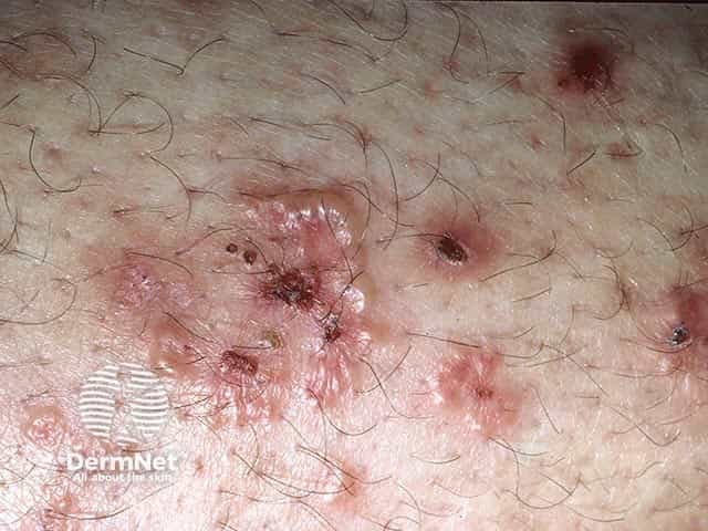 Imaging modality: Clinical photography of a skin eruption on the extensor surface of the elbow. The image shows clustered vesicles and vesiculopapular plaques on an erythematous base with surrounding excoriations and crusts. Lesions are pruritic and arranged in grouped clusters, predominantly on the extensor aspect of the elbow (antecubital region) with variable edema and superficial erosions. The appearance is highly suggestive of dermatitis herpetiformis in the appropriate clinical context, though differential diagnoses include dyshidrotic dermatitis and other vesiculobullous disorders. No biopsy or immunofluorescence data are provided; if obtained, direct immunofluorescence would be expected to reveal granular IgA deposits in dermal papillae, supporting DH. Clinically, DH is associated with gluten sensitivity and celiac disease; patients often present with intensely itchy vesicles that erupt in crops on elbows, knees, buttocks, and scalp. This image captures the papulovesicular eruption with vesicle grouping and crusting after rupture. Diagnostic significance lies in recognizing extensor surface involvement and pruritic grouped vesicles, guiding serologic testing for celiac disease and consideration of a gluten-free diet and dapsone therapy for symptomatic relief. Educationally, the image is useful for pattern recognition of DH, correlation with histopathology, and discussion of differential diagnoses, patient counseling, and clinical management in dermatology and gastroenterology practice.