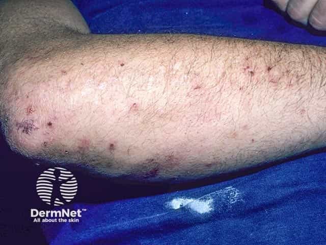 Clinical photograph of a dermatology case showing excoriated vesicles and crusted papules on the forearm, compatible with dermatitis herpetiformis (Duhring disease). The image captures an anterior (volar) view of the upper limb with multiple small erythematous papules and vesicles along the extensor surface, interspersed with crusts from scratching. A few intact vesicles are evident, confirming the vesiculopapular morphology characteristic of DH. The skin appears mildly inflamed with excoriations and postinflammatory crusting, suggesting pruritus-driven disease activity. The distribution on the forearm is typical for dermatitis herpetiformis, which often affects extensor surfaces such as elbows, knees, buttocks, and shoulders. The photograph shows clinically relevant features including clustered vesicles on an erythematous base, clear vesicular rupture sites, and secondary crusts, all consistent with DH lesions in a patient with gluten sensitivity. Visual assessment supports the diagnosis when integrated with clinical history and serology: celiac disease association, pruritic grouped vesicles, and intolerance to dietary gluten. For diagnostic confirmation, skin biopsy with direct immunofluorescence demonstrating granular IgA deposition at dermal papillae is standard; alternative tests include serology for anti-endomysial and anti-tendom gluten antibodies. This image is suitable for dermatology education, clinical case reviews, image atlases, and differential diagnosis studies of vesiculopapular pruritic eruptions.