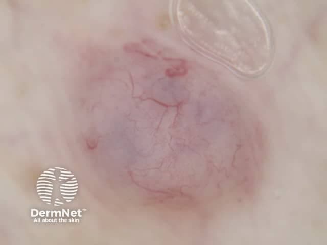 This is a macroscopic, frontal-view clinical photograph of a solitary cutaneous lesion. The exact anatomic site is not specified. The lesion appears as a violaceous-red patch with irregular, ill-defined borders, measuring several centimeters in diameter. The surface is relatively smooth with subtle translucency; underlying vasculature is visible as serpentine superficial vessels within the patch. Mild surrounding erythema and slight edema may be present. The combination of color and vascular pattern raises consideration for superficial bleeding (purpura/ecchymosis) or a vascular lesion such as a capillary malformation, telangiectatic patch, or small-vessel vasculitis; however, a definitive diagnosis cannot be made from a single photograph alone. Observations are suggestive of extravasated blood or mucocutaneous vascular dilation rather than epidermal disruption. Differential diagnoses include ecchymosis, petechiae, palpable purpura, vasculitic rash, pigmented vascular lesions, and inflammatory dermatitis. Clinical significance centers on potential associations with coagulopathy, trauma, infection, or systemic vasculopathy; correlation with history and examination is essential, and if indicated, laboratory testing or skin biopsy may be pursued. This image is educational for recognizing cutaneous vascular phenomena and distinguishing purpuric patches from inflammatory or pigmented lesions, suitable for dermatology atlases and residency training. Additional cases and imaging can improve diagnostic confidence and educational value.