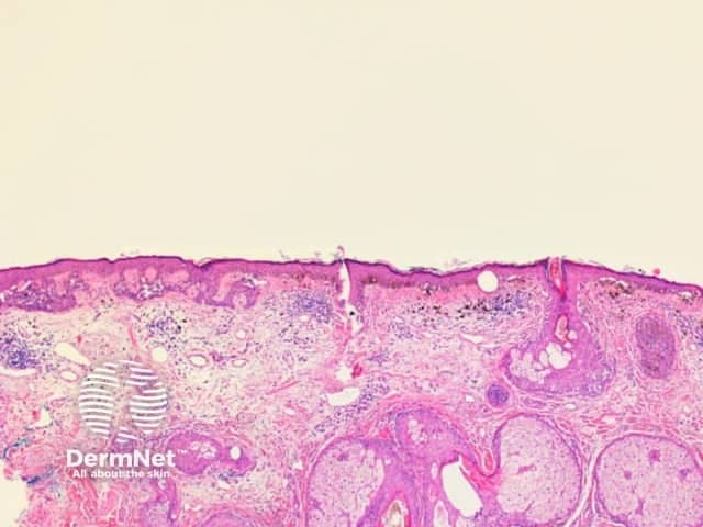 This is a light-microscopy histology image of human skin obtained from a skin biopsy. The section presents a cross-sectional view through the epidermis and dermis, highlighting classic skin architecture suitable for educational comparison. The epidermis shows stratified squamous epithelium with orderly keratinocyte maturation and a clearly visible keratin layer at the surface (stratum corneum). The epidermal-dermal junction appears intact. In the underlying dermis, dense collagenous connective tissue is intermingled with looser fibrous stroma, and adnexal elements such as hair follicles, sebaceous glands, and eccrine glands may be present depending on the field illuminated by the section. Hematoxylin provides purple nuclear detail, while eosin stains the cytoplasm and extracellular matrix pink, creating the familiar purple-pink contrast that delineates structures. No obvious atypia, dysplasia, or malignant invasion is discernible in this field, though assessment is limited to a single plane and context is clinical. The image serves as a reference for normal or near-normal skin histology and can assist in recognizing deviations arising from inflammatory dermatoses, hyperplasia, keratinization disorders, or benign adnexal lesions when correlated with patient history and additional levels. It is relevant for dermatology training, histopathology practice, and educational case discussions.
