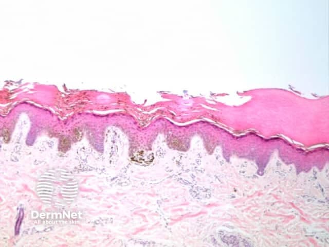 Imaging modality and technique: Light microscopy of a hematoxylin and eosin stained skin biopsy section. Specimen originates from cutaneous tissue, comprising epidermis with stratified squamous epithelium and underlying dermis. Anatomical context: integumentary system; skin organ; epidermis–dermis junction; documented with low magnification cross‑sectional view. Visual features: intact stratified squamous epithelium with multiple keratinocyte layers, prominent stratum corneum, rete ridges descending into the dermis, and a loose papillary dermis with collagenous stroma. The dermoepidermal interface is undisturbed; hair follicle and eccrine structures may be outside image field. No inflammatory cells, necrosis, dysplasia, or malignant features are evident. Staining highlights nuclei in blue (hematoxylin) and cytoplasmic/matrix components in pink (eosin), providing clear delineation of epidermal layers and dermal connective tissue. Diagnostic significance: representative normal skin histology used as a reference for dermatopathology, educational use in anatomy/gross pathology correlation, and comparative assessment in inflammatory dermatoses, autoimmune conditions, or neoplasia. Clinical relevance: baseline atlas image for teaching, slide review, and digital pathology databases; assists students and clinicians in recognizing epidermal stratification, keratinization, and dermal architecture. Clinical scenarios include dermatology education, histology labs, and virtual microscopy datasets, with contrasting examples (psoriasis, eczema, dermatitis, basal cell carcinoma) to illustrate epidermal thickening, rete peg morphology, and inflammatory patterns. Baseline image aids recognition of epidermal thickness and adnexal structures.
