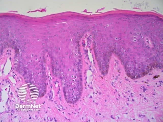 Light microscopy examination of a cutaneous punch biopsy stained with Hematoxylin and Eosin reveals epidermal hyperplasia characterized by acanthosis with elongation of the rete ridges. The stratum corneum shows varying thickness consistent with hyperkeratosis. The epidermal architecture remains orderly without described dysplasia or malignant features. The epidermal-dermal junction is preserved. In the superficial dermis there is a mild perivascular inflammatory infiltrate composed predominantly of lymphocytes and occasional histiocytes, without conspicuous neutrophilic microabscesses. The overall pattern is compatible with a chronic inflammatory or hyperplastic skin process rather than an acute infection. The combination of thickened epidermis, elongated rete pegs, and modest dermal inflammation can be seen in conditions such as chronic dermatitis, atopic dermatitis, or friction-related hyperkeratosis; psoriasis-like acanthosis should be considered if parakeratosis and neutrophils in the stratum corneum are present, which is not definitively demonstrated here. The findings are non-specific and require clinical correlation with lesion morphology, distribution, duration, and patient history. Clinically this image provides educational representation of basic cutaneous histology: epidermal hyperplasia, hyperkeratosis, dermal inflammatory infiltrate, and intact dermal connective tissue. Potential uses include teaching dermatopathology, validating histologic criteria for chronic inflammatory dermatoses, and aiding differential diagnosis discussions in dermatology.