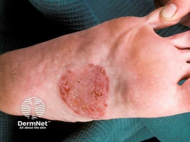 Imaging modality: Clinical photography of a cutaneous lesion on the foot. Anatomic location: dorsum/instep of the foot. The image shows a single, well-demarcated coin-shaped plaque with a erythematous, scaly surface and central crust, located on the instep near the midfoot. The lesion is circular to oval, appearing slightly raised at the edges with a flatter, desquamative center. The surrounding skin appears mildly inflamed without obvious secondary infection. This presentation is characteristic of discoid eczema (nummular dermatitis), a chronic inflammatory dermatosis that produces circumscribed plaques that itch and erode. The plaque displays typical features: polygonal to circular configuration, sharply defined border, erythema, scaling, and crusting from scratching or secondary infection. Differential diagnoses include tinea pedis/ corporis, psoriasis, contact dermatitis, asteatotic eczema, and other papulosquamous or infectious dermatoses. The image highlights the need for correlation with pruritus history, chronic dryness, and potential irritant or allergic exposures. In clinical practice, recognition of discoid eczema guides topical therapy (emollients, medium-potency topical corticosteroids), evaluation for secondary infection, and consideration of phototherapy or systemic therapy in refractory cases. This photograph is relevant for educational demonstration of classic nummular dermatitis morphology on the foot instep and for differential diagnosis training. Correlation with history strengthens diagnostic confidence significantly.