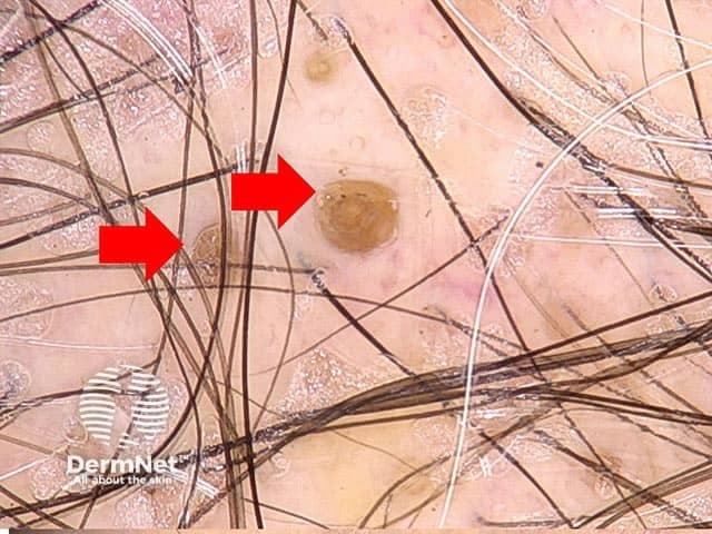 Modality and view: In vivo dermoscopy (dermoscopy) of a discoid lupus erythematosus plaque on scalp skin, captured with noninvasive, magnified close‑up imaging. The primary lesion shows characteristic follicular plugging: round to oval keratin-filled openings that appear as yellow‑brown to tan plaques at the follicular ostia. Surrounding scale is minimal to moderate, with a subtle erythematous halo and fine perifollicular hyperkeratosis evident around plugged follicles. Hair shafts traverse the surface; there is no gross necrosis or ulceration in this field. The plugs are well circumscribed, sometimes surrounded by faint brown pigmentation, which may reflect chronic sun exposure and pigmentary alteration. These dermoscopic findings correlate with discoid lupus erythematosus histopathology, where follicular plugging and interface dermatitis are common. The presence of follicular plugs in a lupus-type plaque is highly suggestive and helps distinguish DLE from inflammatory dermatoses such as seborrheic dermatitis or eczema, where oiliness and scaling predominate without discrete keratotic ostial plugs. Diagnostic significance: dermoscopic follicular plugging supports clinical suspicion of DLE and guides biopsy targeting if confirmation is needed. Potential clinical uses include monitoring activity, treatment response, and differentiation from other scarring alopecias. In clinical practice, this image aids education of residents and researchers in recognizing DLE dermoscopic signatures on scalp skin.