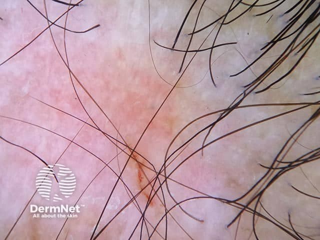 Clinical photography of the scalp depicts discoid lupus erythematosus-associated cicatricial (scarring) alopecia. The frontal to vertex scalp shows patchy erythematous and atrophic plaques with loss of normal follicular openings and hair shafts. Dermal sclerosis and peripilar telangiectasias are evident within affected areas, producing a smooth, scarred surface with diminished skin appendages. The remaining hair is sparse at the lesion margins, emphasizing the irregular scarring process. The vascular pattern includes visible dilated vessels, consistent with telangiectasia, and surrounding mild erythema. Overall morphology is characteristic of chronic inflammatory scarring alopecia with angular plaque margins and hypo- or hyperpigmented zones. The locoregional involvement on the scalp supports a diagnosis of discoid lupus erythematosus, a cutaneous manifestation of lupus erythematosus. The image captures essential features used for differential diagnosis from non-scarring alopecias and other cicatricial conditions, including lichen planopilaris and frontal fibrosing alopecia. The finding has clinical significance for patient management, as DLE may respond to antimalarial therapy and sun protection, and chronic inflammation risks progression to deeper dermal damage. This image is valuable for dermatology education, cicatricial alopecia research, and documented cutaneous lupus case repositories; it informs pattern recognition, staging, and treatment planning. Educational use includes pattern recognition, differential diagnosis, and treatment planning principles.