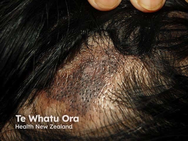This dermatologic clinical photograph depicts a discoid lupus erythematosus (DLE) lesion on the scalp with resulting cicatricial (scarring) alopecia. The image shows an irregular, hypopigmented-to-erythematous plaque at the scalp margin with a central area of hair loss and complete disruption of hair follicles, producing permanent scarring. The patch is bordered by a slightly erythematous, scaly margin and perifollicular hyperpigmentation. Follicular openings are diminished or obliterated in the affected zone, consistent with cicatricial alopecia. The surrounding skin may appear atrophic, with subtle pigmentary changes typical of chronic discoid lupus. Clinically, the pattern is localized and plaque-like, most commonly affecting sun-exposed scalp regions; DLE lesions may coalesce or evolve over weeks to months. This entity is part of the lupus erythematosus spectrum and carries diagnostic significance for autoimmune dermatology; histopathology would reveal interface dermatitis with basal cell vacuolization, periadnexal lymphocytic infiltrate, follicular plugging, and dermal sclerosis. Differential diagnosis includes lichen planopilaris, frontal fibrosing alopecia, and other scarring alopecias. Management implications include antimalarial therapy, topical steroids, calcineurin inhibitors, photoprotection, and rheumatology assessment for systemic involvement. This image serves educational purposes for dermatology, rheumatology, and medical training in recognizing cicatricial alopecia patterns associated with discoid lupus.