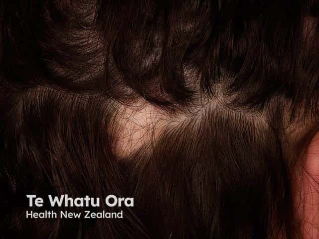 This is a clinical scalp photograph documenting discoid lupus erythematosus (DLE)–associated scarring alopecia. The image shows a localized left-parietal scalp patch with hair loss persisting in the focal area, featuring an atrophic center and a clearly defined, active-appearing border. Surrounding skin may display mild erythema and scaling; follicular openings are diminished or absent within the scar, consistent with cicatricial alopecia. Visual cues—well-demarcated plaque with scarring—help distinguish DLE from non-scarring alopecias such as androgenetic alopecia or alopecia areata in this clinical setting. This photograph supports dermatologic assessment, documentation of disease extent, and monitoring of progression or response to therapy. Clinically, DLE on the scalp necessitates biopsy confirmation when uncertain, photoprotection, and consideration of antimalarials or immunosuppressants depending on activity and systemic involvement risk. The image is suitable for education, differential diagnosis exercises, and research into scarring mechanisms, disease activity, and treatment outcomes. When correlated with histopathology and serologic data, it aids in comprehensive lupus evaluation and longitudinal patient management.