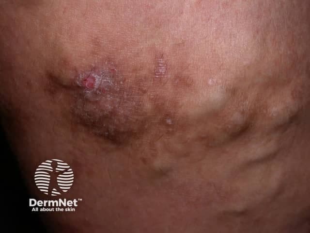 This is a color clinical photograph of the lower leg illustrating chronic venous insufficiency manifesting as varicose dermatitis or stasis dermatitis. The image highlights typical stasis changes including brown hemosiderin pigmentation, edema with thickened, leathery skin (lipodermatosclerosis), and eczematous plaques with crusting and fissures; hyperpigmented patches extend around the medial malleolus and distal lower leg. A shallow ulceration or crusted erosion may be present in the affected zone, accompanied by surrounding erythema. The appearance is consistent with chronic venous hypertension and venous stasis, rather than acute infection. Clinically relevant features include chronic edema, skin induration, and pigmentation, with potential secondary infection risk. This image can aid in diagnosing stasis dermatitis, differentiating from cellulitis or contact dermatitis, and evaluating response to therapy such as compression stockings, leg elevation, emollients, and anti-inflammatory topical agents. Educational use cases include dermatology exams, vascular medicine training, and wound care planning; also useful for illustrating differential diagnoses of leg edema-related dermatitis and for teaching recognition of lipodermatosclerosis. High-quality imaging helps learners connect clinical signs with pathophysiology of venous insufficiency, including microvascular hemosiderin deposition, edema-driven skin changes, and chronic inflammatory processes that predispose to ulcer formation. This image is suitable for bedside teaching and exam review purposes.