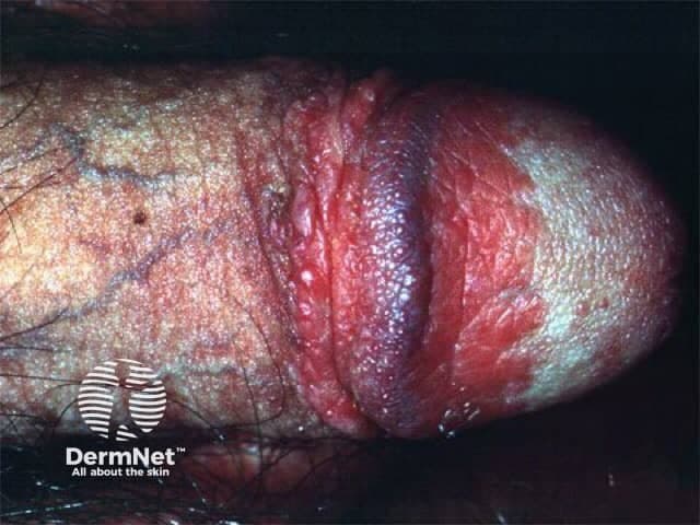 Clinical photography of penile skin demonstrates an external genital dermatosis. Imaging modality: Clinical photography using macro close-up illumination to capture surface texture. Anatomy: Penile skin encompassing the glans and distal shaft, with partial foreskin retraction exposing the coronal sulcus. Location/accessory terms: genital skin, balanitis-prone areas; body system integumentary. Visual features: diffuse erythema with raised red plaques, shiny, moist surface, mild edema, and areas of desquamation along the penile shaft and preputial skin. There is no discrete ulceration or purulent discharge evident in this image. The features are suggestive of balanitis-like dermatitis, irritation, or inflammatory dermatopathy rather than acute infection; however, candidal balanitis or bacterial balanitis remains in differential. Inflammatory patterns may include contact dermatitis, eczema, or psoriasis variants localized to genitalia. Diagnostic significance: Highlights a common genital dermatosis amenable to topical therapy; assists in distinguishing inflammatory dermatoses from infectious etiologies. Clinical use cases: educational reference for dermatology and urology trainees; differential diagnosis in patients with erythema, edema, and plaques on the penis; guides management such as hygiene measures, barrier creams, antifungal or anti-inflammatory agents; aids patient counseling about symptom monitoring and treatment response. Clinical correlation with history, symptoms, and potential secondary infection is essential for accurate diagnosis and treatment planning.