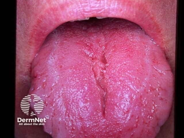 Clinical photograph of the dorsum of the tongue showing fissures. The tongue displays multiple longitudinal grooves with a grooved, rugose surface and interspersed smooth areas; mucosa is pink and moist, with no ulceration or mass effect evident. This presentation corresponds to fissured tongue (lingua fissura), also termed scrotal tongue, a benign morphological variant of the oral mucosa. The fissuring pattern can be diffuse or regional, often more prominent on the central dorsum and midline, and may be accentuated by tongue movement. In many individuals it is asymptomatic, but some report mild irritation or burning, particularly with spicy or acidic foods. Associated phenomena include geographic tongue (benign migratory glossitis) or, less commonly, syndromic contexts such as Melkersson-Rozensky; however, most cases occur in isolation and lack systemic disease. Differential diagnoses include inflammatory glossitis, candidal fissures in immunocompromised patients, nutritional deficiencies (iron, ferritin, vitamin B12, folate), or dermatologic tongue variants. Clinically significant findings include absence of focal swelling, ulceration, or neoplasia. The diagnostic significance lies in recognizing a benign mucosal variant and distinguishing it from inflammatory or infectious processes. Management focuses on reassurance, meticulous oral hygiene, avoidance of irritants, and symptomatic relief if irritation is present; consider nutritional assessment if symptoms persist.
