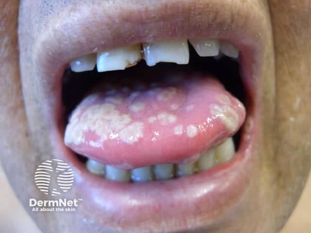 Clinical photograph of the oral cavity documenting mucosal vesicles and erosions associated with suspected herpes simplex infection. The image shows diffuse mucosal involvement of the tongue with white to yellowish plaques, and scattered vesicular lesions along the gingiva and buccal mucosa with mild surrounding erythema. The tongue surface is swollen, with a smooth, shiny appearance; plaques are patchy, and some vesicles have ruptured, leaving shallow erosions covered by pseudomembranous debris. Lips and labial mucosa may show fissuring and crusting. Notable absence of radiographic features. This morphological pattern is typical of primary herpes simplex virus type 1 infection, more common in pediatric patients and in primary exposure. Clinically, vesicles progress to painful ulcers with erythematous halos; fever, irritability, and reduced oral intake are common. Differential diagnoses include candidiasis, aphthous stomatitis, erythema multiforme, and recurrent herpetic lesions. Diagnostic significance: recognition of classic mucocutaneous HSV pattern supports prompt antiviral therapy (acyclovir) and can shorten illness; confirmatory testing from a lesion (PCR, viral culture, or antigen assays) may be employed. Clinically correlate with recent exposure to orolabial HSV, gingivostomatitis symptoms, and systemic signs. This image is educational for recognizing orofacial HSV lesions, guiding differential diagnosis, and illustrating progression from vesicles to ulcers in dermatology and infectious disease training.