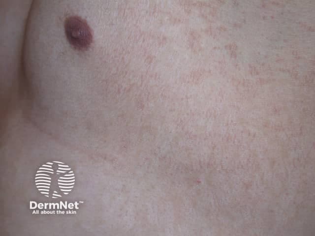 This clinical photograph shows a single, well-circumscribed pigmented patch on the skin, characteristic of pityriasis versicolor (Malassezia infection) presenting as a hypo- or hyperpigmented macule. Imaging modality: clinical photography; perspective: close-up surface view of skin. Anatomic location: cutaneous surface within the integumentary system; region not specified on this image. Visual features: circular to oval plaque with a slightly raised, well-defined border; color ranges from reddish-brown to tan relative to surrounding skin; surface may be smooth with minimal desquamation or fine scale detectable on close inspection. The lesion lacks overt edema or ulceration. In the differential diagnosis, other hypo-/hyperpigmented patches such as pityriasis alba, vitiligo, seborrheic dermatitis, postinflammatory hyperpigmentation or tinea corporis could appear similar, but the combination of color, scale, and trunk distribution often points toward Malassezia-associated disease. Notably, pityriasis versicolor commonly occurs in warm, humid climates and can fluoresce yellow-green under Wood's lamp; KOH microscopy often demonstrates the characteristic 'spaghetti and meatballs' pattern. Clinically, lesions are usually asymptomatic or mildly pruritic and can coalesce; treatment is topical antifungals (azole or allylamine) or oral antifungals in extensive disease. This image serves educational purposes for dermatology training, primary care screening, and triage in infectious dermatoses, and can be used in machine learning datasets for skin disease recognition, highlighting malassezia-related pigmentary disorders.