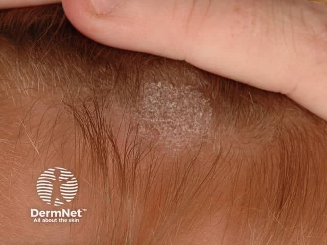 This is a high-resolution clinical photograph of a localized scalp lesion suspicious for tinea capitis (scalp ringworm). Modality: Clinical photography; technique: macro close-up digital image with diffuse, realistic lighting; no dermatoscopic pattern or fluorescence. Anatomical location: Scalp, especially near the temporal hairline; integumentary involvement. The lesion appears as an annular plaque with a grey to pale scale-coated surface and a distinct active border of peripheral scaling. Central clearing is evident, with hair thinning and mild perifollicular scaling. Surrounding skin shows normal pigmentation and mild dryness. Pattern is localized/unilateral. Differential diagnoses include dermatophyte infection (tinea capitis), seborrheic dermatitis, discoid lupus erythematosus, psoriasis capitis, and eczema. Clinically significant for fungal infection; warrants fungal testing (KOH microscopy, culture) and antifungal therapy. Management may involve systemic antifungals (e.g., griseofulvin, terbinafine in children) or topical agents for limited involvement; assess for hair shaft breakage and monitor resolution. This image is valuable for education on ringworm morphology, differential diagnosis, and clinical decision-making in pediatric dermatology. Clinical follow-up and dermoscopy may further delineate perifollicular inflammation and guide antifungal choice.