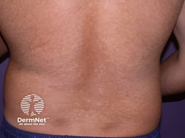 Clinical photography of the back using a high‑resolution digital camera under standard white‑light illumination was obtained to document cutaneous skin findings. The view is a posterior trunk (dorsal back) with bilateral, well‑circumscribed hypopigmented macules and patches showing fine surface scaling. Lesions are diffuse across the mid to lower back with mild contrast against surrounding tan skin, consistent with pityriasis versicolor (tinea versicolor). The textural appearance is smooth, with less erythema than inflammatory dermatoses; scaling is subtle and best appreciated on oblique lighting. Pityriasis versicolor is a superficial fungal infection caused by Malassezia species that disrupt epidermal pigmentation, producing hypo‑ or hyperpigmented macules and mild pruritus in some patients. The condition commonly affects the trunk and proximal limbs in warm, humid climates and may be asymptomatic. In the differential diagnosis, vitiligo, pityriasis alba, and postinflammatory hypopigmentation are considerations. If tested, KOH preparation or fungal culture can reveal yeast with short hyphae (“spaghetti and meatballs”) compatible with Malassezia species. Management typically involves topical antifungals; extensive cases may require oral therapy. This photograph serves educational and reference purposes for pattern recognition, trunk involvement, and characterization of pigmented skin lesions in dermatology practice and training.