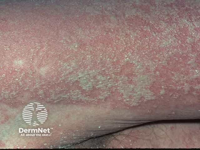 This is a macroscopic dermatologic clinical photograph illustrating a generalized pustular eruption consistent with active generalized pustular psoriasis (GPP, von Zumbusch type). Imaging modality: Dermatology clinical photography, close‑up macro view of the skin surface. Specimen: Skin surface; anatomical region primarily trunk and proximal limbs with diffuse involvement. The image shows numerous superficial sterile pustules embedded in an erythematous, moist to crusted plaque‑like background. Pustules are nonfollicular, variably sized, some coalescing into larger lakes of pus, with peripheral pale halos. The surrounding skin is markedly inflamed with diffuse erythema, edema, and fine-scale desquamation; subtle fissuring may appear at flexural regions along the periphery. The pattern is generalized and widespread with symmetric distribution, lacking a discrete lesion. No visible mucosal involvement is shown in this field; however, mucosal dryness and systemic symptoms may accompany GPP. Clinically, this presentation prompts urgent assessment for fever, electrolyte disturbances, and potential systemic involvement (hepatic, renal, hematologic). Diagnostic significance: hallmark pustular eruptions on erythema suggest GPP; differential includes acute generalized exanthematous pustulosis (AGEP) and other pustular psoriasis variants; correlate with history, laboratory data, and biopsy if indicated. Potential use cases: dermatology education, image-based differential diagnosis practice, AI triage reference, and teaching aid for recognizing pustular psoriasis presentations.