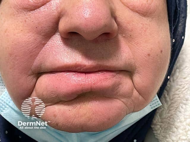 Clinical photography of the perioral region shows diffuse lower-lip edema attributable to granulomatous cheilitis, a manifestation of orofacial granulomatosis subsequently associated with Crohn disease. The frontal facial view emphasizes swelling of the lower lip with mucosal erythema, a thickened vermilion border, and subtle tightening of perioral folds. No acute mucosal ulceration is evident; soft-tissue expansion dominates the phenotype. The case notes progression to gastrointestinal Crohn disease, underscoring the well-established link between orofacial granulomatosis and intestinal inflammatory bowel disease. This image exemplifies lip involvement as a prominent extraintestinal sign that may precede or accompany GI symptoms. Differential considerations include cheilitis granulomatosa, orofacial granulomatosis, sarcoidosis, Melkersson-Rosenthal syndrome, and angioedema or contact cheilitis. Imaging modality is clinical photography with a color-balanced digital capture, using a standardized frontal orientation and no contrast or staining. Pathophysiology involves granulomatous inflammation causing localized edema of the lips and perioral tissues. Clinically, recognition of orofacial granulomatosis as a potential early marker of Crohn disease supports prompt GI evaluation, histologic confirmation when indicated, and multidisciplinary management with dermatology and gastroenterology. Educational and research use includes dermato-gastroenterology correlation, case-based teaching, and dataset enrichment for orofacial granulomatous disease. This image supports education, research annotation, and algorithmic retrieval of granulomatous lip disease.