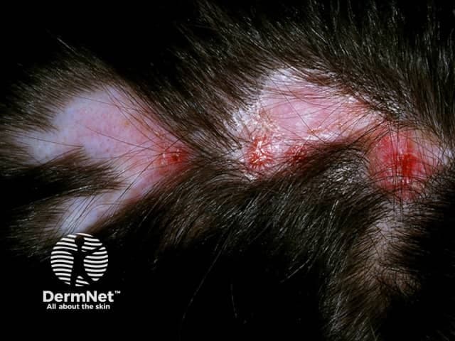 Clinical photography of a discoid lupus erythematosus lesion localized to the scalp/behind the ear demonstrates a solitary, well-demarcated erythematous plaque with adherent scale and thinning hair in the involved region. The plaque exhibits a raised red to violaceous border, a potentially atrophic center, and variable crusting, consistent with the classic morphology of DLE. Follicular plugging and surrounding erythema are common features, contributing to patchy hair loss (scarring alopecia) if chronic. The presentation is sun-exposed surface-limited, suggesting photosensitive cutaneous involvement. Imaging modality is non-invasive, relying on standard white-light clinical photography to document surface texture, scale, and border definition. Differential diagnoses include psoriasis of the scalp, tinea capitis, seborrheic dermatitis, cutaneous lupus erythematosus, lichen planus, and less likely basal cell carcinoma with ulceration on the scalp. Confirmation typically requires correlation with histopathology showing interface dermatitis with lymphocytic infiltrate and follicular involvement, and possibly direct immunofluorescence. Clinically, discoid lupus requires monitoring for progression to systemic lupus erythematosus, especially in patients with widespread disease or mucocutaneous involvement. Management emphasizes sun protection, avoidance of triggers, topical corticosteroids, calcineurin inhibitors, photoprotection, and, in selected cases, antimalarial therapy. This image is valuable for education on recognition, differentiation, and early diagnosis of discoid lupus erythematosus in dermatology training.