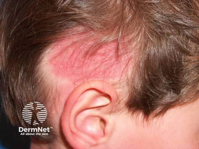 Imaging modality: Clinical photography of the scalp using standard external photography. The image depicts the left temporal/parietal scalp in a pediatric patient, showing a circular to oval erythematous patch with fine scaling and hair shedding compatible with tinea capitis (scalp ringworm). Visual features include a well-demarcated plaque, superficial crusting at the margins, and accentuated perifollicular erythema around affected follicles. Hair within the lesion appears sparse or broken, and surrounding skin is normal or mildly irritated, with no deep dermal involvement evident. The underlying pathophysiology is dermatophyte invasion of keratinized structures, most commonly Microsporum or Trichophyton species, leading to inflammatory alopecia and patchy hair loss. Clinically this appearance supports a differential diagnosis that includes tinea capitis, seborrheic dermatitis, and inflammatory scalp conditions; however, the combination of erythema, scaling, and patchy alopecia favors a fungal etiology. Diagnostic significance lies in recognizing a contagious dermatophyte infection requiring mycologic confirmation (KOH preparation, fungal culture, or Wood lamp examination when indicated). Potential clinical uses include guiding early antifungal therapy, infection control counseling, and educational demonstration of scalp dermatophytosis for medical training. This image serves as a case-based reference for dermatology, pediatrics, infectious disease education, and clinical dermatopathology.