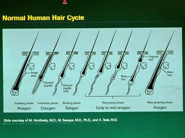This educational diagram depicts the Normal Human Hair Cycle in a longitudinal schematic of a pilosebaceous unit from the scalp. Modality: Educational illustration; not an in vivo imaging study. Technique: Digital vector illustration with color-coded phases to aid rapid recognition. Anatomy shown includes the scalp hair follicle, hair shaft, hair bulb, dermal papilla, outer root sheath, bulge region, and associated sebaceous gland. Phases represented are Anagen (growth phase) with active matrix proliferation and elongation of the hair shaft; Catagen (transitional phase) with follicular involution and brief regression; Telogen (resting phase) with a quiescent follicle and club hair waiting for shedding; and Exogen (shedding phase) illustrating release of a mature hair and initiation of a new anagen cycle. Notable features emphasize the continuous cyclic renewal of the pilosebaceous unit, directional Bow-like angles of hair emanation, and the temporal sequence that governs production of long continuous hair versus short sparse hair. Clinical significance includes the ability to explain common hair disorders: telogen effluvium from premature shift to telogen, androgenetic alopecia from shortened anagen duration, and anagen effluvium from abrupt matrix disruption. Contextual applications span medical education, patient counseling, and research into hair biology, growth factors, and therapeutic interventions aimed at prolonging anagen or modulating cycle duration.