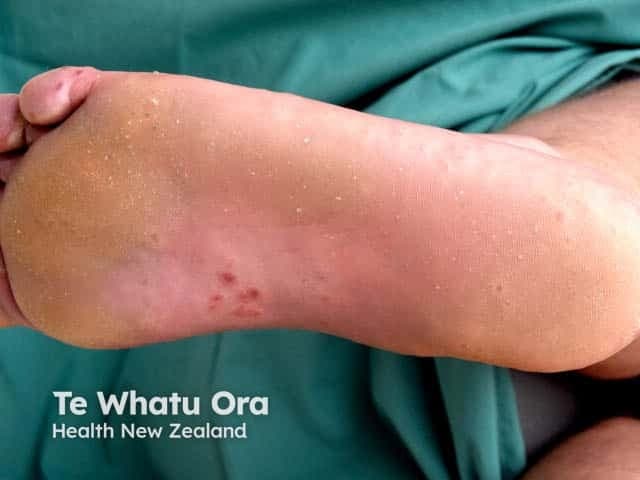 Clinical photography of a pediatric foot plantar surface demonstrates vesicular lesions consistent with hand-foot-mouth disease (HFMD) involving the instep and toes. The image captures small, 1–3 mm vesicles and papules with clear vesicular roofs, some with adjacent erythema and mild edema. Several lesions appear isolated while others are clustered along pressure-bearing areas of the instep and toe pads. In early stages, vesicles are translucent; as they evolve, superficial erosions and crusts may form. The surrounding skin remains largely intact, and there is no evidence of purulence. No mucosal involvement is evident in this view, though HFMD commonly involves oral mucosa and presents with fever and malaise in children. Etiology is enteroviral, predominantly Coxsackievirus A16 or enterovirus 71. The image is valuable for dermatologic morphology education, aiding recognition of acral vesiculopapular eruptions and differentiation from varicella, pompholyx, eczema, or contact dermatitis. It supports clinical correlation with systemic symptoms and oral findings, guides triage, infection control, and patient counseling. For researchers, it illustrates lesion topography on the plantar surface and helps quantify lesion density and progression over time. This photograph emphasizes the characteristic distribution on the feet with toe involvement and instep involvement, reinforcing a HFMD diagnosis in pediatric patients.