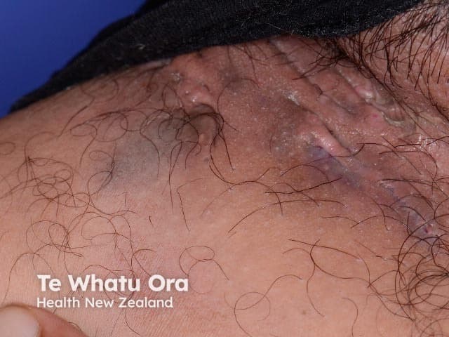 Clinical photograph of the groin region depicting hidradenitis suppurativa (acne inversa) in an intertriginous fold. Imaging modality: Clinical photography; Technique: macroscopic, color-corrected, frontal/anterior view of the inguinal area emphasizing skinfolds and surface lesions. Precise anatomical location: inguinal region with involvement of perineal skin and upper thigh junction; tissue involvement: dermis and superficial subcutaneous tissue with sinus tract formation. Visual features: inflamed, tender nodules and indurated plaques; draining sinus tracts with crusts and purulent exudate; surrounding erythema, edema, hyperpigmented scars, and tethering of the skin. Pathological correlation (clinical): chronic follicular occlusion precipitates abscess formation and sinus tract networks; histology would show follicular rupture with granulomatous inflammation around hair follicles and apocrine-bearing skin. Clinical significance: HS is a relapsing inflammatory dermatosis causing pain, malodor, scarring, and potential secondary infection; differential diagnoses include folliculitis, furunculosis, infected cysts, and cutaneous Crohn’s disease in some contexts. Diagnostic and educational value: helps stage disease (Hurley I–III), guides management including antibiotics (doxycycline, clindamycin–rifampin), biologics (adalimumab), hormonal therapy, and surgical planning. Use cases: documentation for baseline severity, progress monitoring, resident education, patient counseling, and research datasets; groin HS visualization supports dermatology, surgery, and primary care workflows. Images serve as illustrative teaching aids and research data.