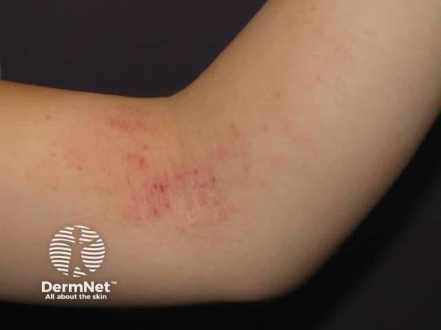 Clinical photography of a pediatric patient highlighting flexural atopic dermatitis in the antecubital region. Modality: Clinical photography (dermatology imaging) captured in color with standard resolution and natural lighting to preserve skin tone. Anatomical context: integumentary system; anterior elbow flexure (antecubital fossa) on the child’s left or unspecified arm. Visual features: erythematous, ill-defined plaques within the flexural creases with mild edema, background skin showing xerosis and secondary excoriations from pruritus; surface may be slightly lichenified and scaly; mild edema and fissuring at the skin folds; distribution is bilateral or unilateral depending on the patient but the image shows a prominent lesion in the flexural area. Pathology: clinical appearance consistent with pediatric atopic dermatitis (atopic eczema) rather than irritant contact dermatitis; features include chronic-relapsing eczema with pruritus, lichenification, and dry skin in flexures. Diagnostic significance: supports a diagnosis of childhood atopic dermatitis with flexural involvement; helps educate on typical morphological pattern and aids in differential diagnosis versus seborrheic dermatitis, contact dermatitis, or psoriasis in pediatric patients. Clinical use: assessment of disease extent, monitoring response to therapy (emollients, topical corticosteroids, calcineurin inhibitors), patient education, and training for students. This image serves as an educational reference for recognizing flexural eczema patterns across age groups and guiding noninvasive management decisions.