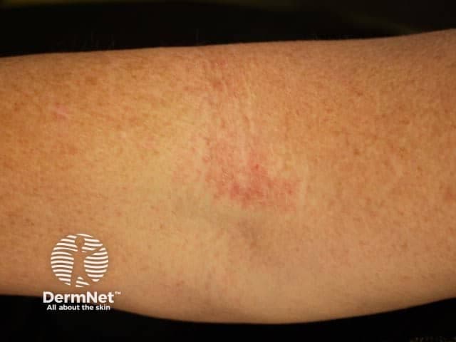 Clinical photography of ventral forearm skin showing atopic dermatitis. Imaging modality: Dermatologic clinical photography; close-up, color-balanced capture suitable for visual examination and comparison over time. Anatomical region: antebrachial skin of the forearm; left/right not clearly discernible in the image. Visual features include diffuse erythema with ill-defined, sometimes coalescent plaques, fine scale, mild xerosis, and subtle lichenification. Excoriations from scratching may be present, reflecting pruritus-driven scratching. The appearance is consistent with chronic inflammatory eczema, not acute infection; edema is mild. Distribution appears localized to a distal forearm segment; flexural bias is possible but not required in adults. This pattern aligns with atopic dermatitis or eczema, though differential diagnoses include contact dermatitis, nummular eczema, seborrheic dermatitis, or psoriasis in overlapping cases. When correlated with clinical history (pruritus, atopy, family history, dry skin), the diagnosis of atopic dermatitis is favored. If histology were obtained, findings would typically include spongiotic epidermal changes with perivascular lymphocytic infiltrate. This image is clinically relevant for education, teledermatology triage, and documentation of lesion morphology, severity, and distribution. Potential clinical use cases include baseline documentation, monitoring therapeutic response (emollients, topical corticosteroids, calcineurin inhibitors), and patient counseling on trigger avoidance and skin care.