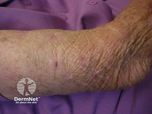 Clinical photography of a forearm demonstrates multiple small pink to violaceous papules with excoriations and crusting, arranged in scattered clusters along the dermal forearm. The skin surface is dry with mild scaling and subtle lichenification, consistent with chronic scratching. Several lesions appear as raised nodules or plaques, while other areas show shallow erosions and crusts, reflecting ongoing pruritus. The overall appearance is typical for scratched prurigo or prurigo nodularis, a chronic pruritic dermatosis. Under visible light, the lesions lack erythematous halo or vesiculation and do not display ulceration. The forearm location corresponds to a commonly affected cutaneous site in prurigo, with possible involvement of flexural or extensor surfaces depending on scratching behavior. The imaging modality is a standard clinical photograph (visible light), with close-up field to highlight individual lesions and textural changes. Pathologically, prurigo nodularis features epidermal hyperplasia, hyperkeratosis, and dermal inflammatory infiltrates; however, histology is not provided here. Clinically, prominent pruritus, scratching-induced excoriations, and nodular formation support a diagnosis of prurigo nodularis or chronic pruritus with secondary prurigo. This image is relevant for dermatology education, lesion recognition, and machine learning datasets for itch-related dermatoses, differential diagnosis, and treatment planning. Further evaluation may include pruritus assessment and screening as needed.