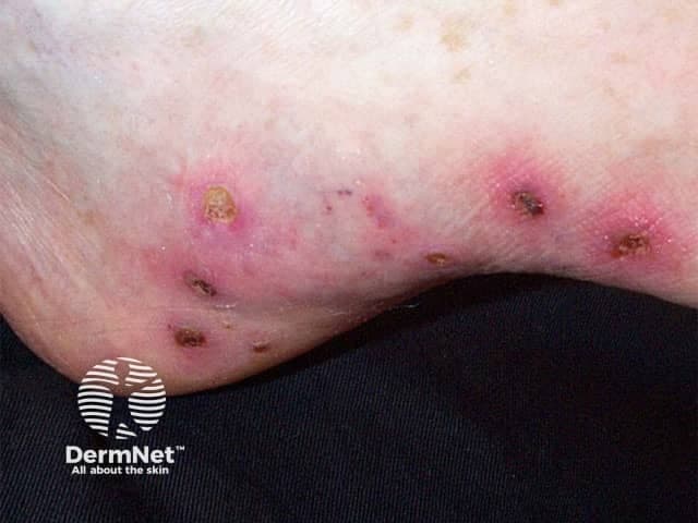Clinical photograph of the lower extremity skin showing palpable purpura typical of cutaneous small-vessel vasculitis. Modality: digital close‑up photography using visible light; magnification approximately macro scale; the image captures multiple erythematous–violaceous papules and patchy plaques with central crusting on the anterior-lateral aspect of the ankle and distal leg. Edema is mild; lesions appear non-blanching with surrounding erythema; some lesions demonstrate necrotic crusts and pigmented halos. The distribution is predominantly on extensor surfaces of the lower leg, consistent with common presentation of leukocytoclastic vasculitis. Skin biopsy, if performed, would be expected to show leukocytoclasia with perivascular neutrophilic infiltration and immune complex deposition; correlate with immune-mediated processes. The image illustrates a dermatologic finding that may be isolated to the skin but can accompany systemic vasculitis or secondary etiologies such as infection, drugs, autoimmune diseases, or IgA vasculopathy (Henoch-Schönlein purpura). Clinically relevant significance includes differentiation from purpura due to thrombocytopenia or coagulopathy; the presence of palpable purpura warrants laboratory evaluation (CBC, inflammatory markers, complements, IgA, serum cryoglobulins) and careful history for recent medications or infections. Use cases include dermatology education, vasculitis teaching files, and assisting in triage for systemic workup. This image supports clinical correlation, patient counseling, and multidisciplinary consultation as needed promptly.