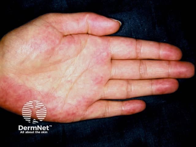 Clinical photography of the palmar surface (volar aspect) of the hand demonstrating palmar erythema, a cutaneous vascular sign often associated with liver disease. Modality: Clinical photography; color image captured under bright, diffuse illumination to show true erythema without shadowing. Anatomical location: palm (thenar and hypothenar regions) of the hand; symmetric or asymmetric involvement may be observed, though the provided image shows patchy diffuse redness along the palmar creases. Visual features include diffuse, blanchable erythema most prominent on the central palmar regions; warm appearance; minimal or absent edema; no vesicles or scaling evident. Pathophysiology: estrogen-mediated cutaneous vascular dilation; may reflect hepatic dysfunction with portal circulation alterations or hyperestrogenism. Diagnostic significance: Palmar erythema can indicate liver disease (cirrhosis, chronic hepatitis, alcoholic liver disease) or conditions with elevated estrogen; in pregnancy or with estrogen therapy it may appear similarly. Differential considerations include pregnancy-related erythema, drug-induced flushing, autoimmune or rheumatologic conditions, and vasculitis; clinical correlation with liver function tests (ALT/AST, ALP, bilirubin, albumin), coagulation profile, and portal hypertension signs is essential. Clinical relevance: serves as a non-invasive bedside sign prompting hepatology evaluation, risk stratification, and longitudinal monitoring; useful in medical education to illustrate cutaneous markers of systemic disease and to teach differential diagnosis in dermatology and internal medicine.