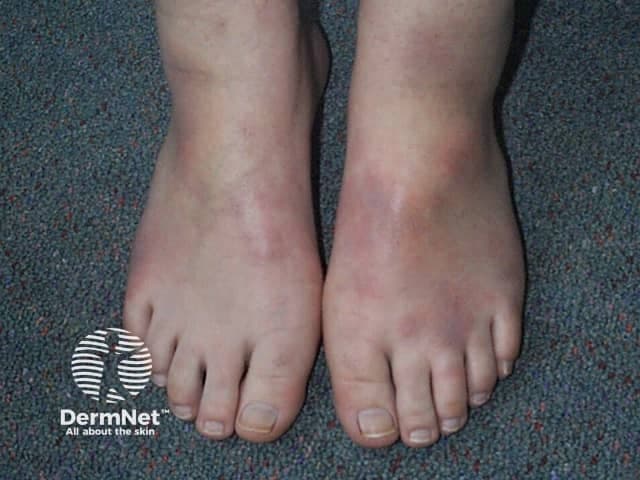 Clinical photography of erythema nodosum on the bilateral lower legs and ankles. The image demonstrates multiple tender, erythematous nodules with raised, firm, subcutaneous plaques located along the pretibial region and extending to the ankles. Color and texture provide contrast against the pale skin of the dorsal feet, highlighting the typical nodular morphology, subtle edema, and differential shading from acute inflammation. The lesions are non-ulcerated, with no purpura, necrosis, or vesiculation evident. This dermatologic presentation aligns with septal panniculitis confined to the subcutaneous adipose tissue, commonly associated with infections (streptococcal pharyngitis), medications, pregnancy, inflammatory diseases (sarcoidosis, inflammatory bowel disease), or hypersensitivity reactions. The image is intended for educational reference, illustrating the characteristic distribution pattern—bilateral, symmetric pretibial nodules on the lower extremities—and the brisk clinical correlation with systemic symptoms such as fever or arthralgia that may accompany erythema nodosum. Radiologic or histopathologic correlation would be pursued if underlying etiologies are suspected. In practice, this finding prompts clinicians to evaluate recent infections, medication exposure, or systemic disorders, and to initiate targeted investigations or empiric therapy while observing for resolution over weeks. Overall, the representation provides a concise visual guide for recognition, differential diagnosis, and management planning in dermatology and internal medicine. Reference resources.