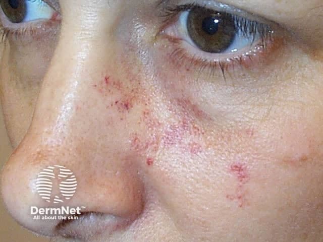 This clinical photograph captures the central facial region, focusing on the nose and malar areas. Modality and technique: noninvasive, standard color dermatologic photography with natural illumination; no dyes or contrast agents used. Anatomical location includes the nasal dorsum, alar rims, and adjacent cheeks in an in vivo adult patient. Visual features: numerous small erythematous papules scattered along the nasal bridge and malar areas, occasional focal crusting, mild surface desquamation, and subtle background erythema; skin texture appears slightly rough with enlarged pores in the nasal region. There are no confluent plaques or obvious pustules of large size evident in this field. Pathology suggested: inflammatory papules with superficial vascular dilation; differential includes papulopustular acne, rosacea, folliculitis, and contact dermatitis. Diagnostic significance: indicates an inflammatory facial dermatosis; may reflect early rosacea or acneiform eruption; the absence of comedones would argue against classic acne. Clinical correlation: patient history (onset, triggers, facial flushing, ocular symptoms) is essential; treatment implications include topical therapies (azelaic acid, metronidazole) or systemic antibiotics for rosacea or acne, with monitoring for response and adverse effects. Potential clinical use: educational reference for dermatology training, differential diagnosis discussion, telemedicine skin assessments, and therapy tracking. Useful for clinical education, case discussions, and image-guided assessment.
