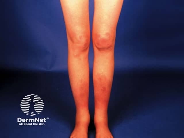 Clinical photograph of the anterior lower legs (bilateral shins) in frontal view, acquired as a color digital image for dermatologic assessment. The image depicts multiple erythematous, raised nodules concentrated over the pretibial regions, symmetrically distributed on the shins with mild surrounding edema and no ulceration. The nodules are tender to palpation in typical erythema nodosum patterns and lie within the subcutaneous tissue just below the dermis. This presentation is characteristic of erythema nodosum, aseptal panniculitis without vasculitis, which may accompany infectious (streptococcal pharyngitis), medication-related, or systemic conditions such as sarcoidosis and inflammatory bowel disease. The clinical diagnosis is supported by the symmetry and localization to the anterior lower legs, a common site. In differential diagnosis, erythema induratum (nodular vasculitis), lipodermatosclerosis from venous insufficiency, cellulitis, and other panniculitides should be considered. The image serves educational purposes and aids teledermatology assessment, patient triage, and documentation of cutaneous nodules. If biopsy were performed, histology would typically show septal panniculitis without vasculitis; occasional Miescher radial granulomas may be observed in EN, correlating with chronicity. Management emphasizes treating underlying cause and symptomatic relief with NSAIDs and leg elevation. Documentation of lesion evolution over time and response to therapy can guide assessment of etiologic triggers and inform prognosis.