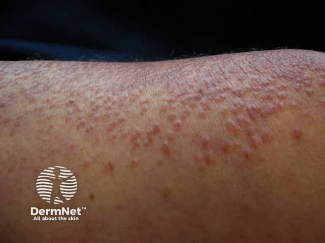 This is a high-resolution clinical photograph of the skin on the forearm, showing diffuse, numerous small keratotic follicular papules on a pink-to-skin-toned background. Imaging modality: clinical photography with macro close-up. Lesions are 1–3 mm, sessile, follicular papules with central keratotic plugs and surface roughness; mild perifollicular erythema; no pustules. The pattern and morphology are classic for keratosis pilaris (follicular hyperkeratosis), a common benign dermatologic condition often associated with atopy or dry skin. It typically affects extensor surfaces such as arms and thighs. Distinguishing surface features include a rough, sandpaper-like texture and discrete, dome-shaped papules surrounding hair follicles. Differential considerations include folliculitis, eczema with follicular involvement, pityriasis rubra pilaris, and less likely lichen planus or papular syphilids. Clinical significance: primarily cosmetic, generally benign; management emphasizes emollients and keratolytics (urea, lactic acid, salicylic acid) with cautious use of irritants. Potential clinical applications: dermatology education, differential diagnosis practice, baseline documentation, and monitoring therapeutic response. No imaging beyond surface photography; no biopsy performed. The forearm distribution supports extensor-site involvement and is helpful for educational comparisons with similar papular presentations. This image can support patient counseling, track treatment outcomes, and serve as a reference in clinical quizzes highlighting keratotic follicular lesions and benign cutaneous disorders.