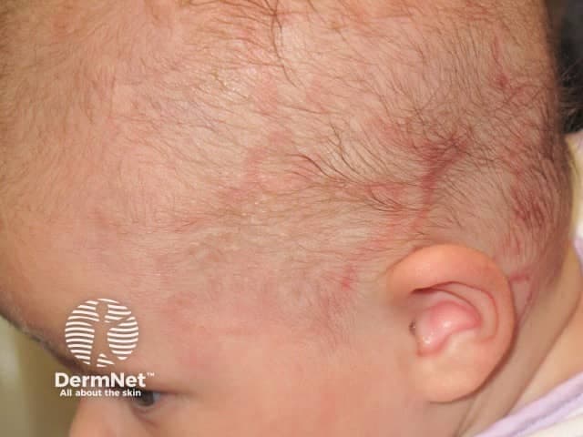 Clinical photograph with standard white-light illumination reveals a newborn scalp demonstrating erythematous, scaly patches along the hair-bearing skin. The lesions are modest in size, primarily clustered near the temporal and frontal scalp, with mild surface desquamation and surrounding mild perilesional erythema. This appearance is characteristic of cutaneous neonatal lupus erythematosus, a transient dermatologic manifestation caused by transplacental passage of maternal autoantibodies (SSA/Ro, SSB/La). The image emphasizes the typical distribution on the scalp in neonates, though other sites such as the face or neck may be involved. Although the cutaneous rash often resolves spontaneously by 6-12 months as maternal antibodies wane, neonatal lupus can be associated with congenital heart block; thus clinical correlation and cardiac surveillance are essential. Differential considerations include seborrheic dermatitis of infancy, atopic dermatitis, tinea capitis, cradle cap, and contact dermatitis. Histopathology (not shown) would demonstrate interface dermatitis with lymphocytic infiltrate and basal vacuolization in affected skin. Management is supportive, focusing on gentle cleansing, ceruminous moisturizers, and judicious topical corticosteroid therapy if inflammation is persistent. This image is valuable for dermatology, neonatal medicine, obstetric-pediatric collaboration, and educational case-based learning about lupus-related cutaneous disease in newborns. Clinically, early recognition supports targeted monitoring for cardiac rhythm abnormalities and long-term follow-up.