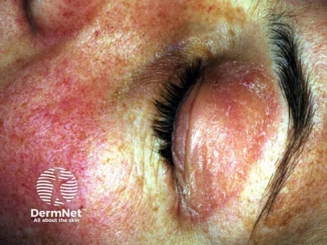 Clinical photography of the left periorbital region demonstrating the hallmark heliotrope rash associated with dermatomyositis. The image shows erythematous to violaceous papery skin surrounding the eyelids with mild edema and rough, flaky texture. The involved lid margin is reddened and slightly swollen; the ambient facial skin displays diffuse erythema and subtle scaling consistent with inflammatory dermatosis. In dermatomyositis, heliotrope rash is a pathognomonic cutaneous manifestation; it may precede or accompany proximal muscle weakness and elevated muscle enzymes. The appearance is typically bilateral and symmetric around the orbit, with sparing of mucous membranes. Additional signs to assess include Gottron papules over extensor surfaces and shawl sign; however these are not visible in this focal image. This photograph serves as documentation of cutaneous involvement used in clinical assessment, disease monitoring, and educational reference for dermatology, rheumatology, and neurology. The image is suitable for keyword-rich indexing: periorbital rash, heliotrope eruption, dermatomyositis cutaneous signs, eyelid edema, violaceous erythema, facial dermatitis, inflammatory dermatosis, autoimmune myopathy, DM, proximal muscle weakness correlation, differential diagnoses include eczema, lupus pernio, contact dermatitis, photosensitive dermatitis. Clinical relevance includes screening for underlying malignancy in adults and guiding multidisciplinary evaluation for myositis.