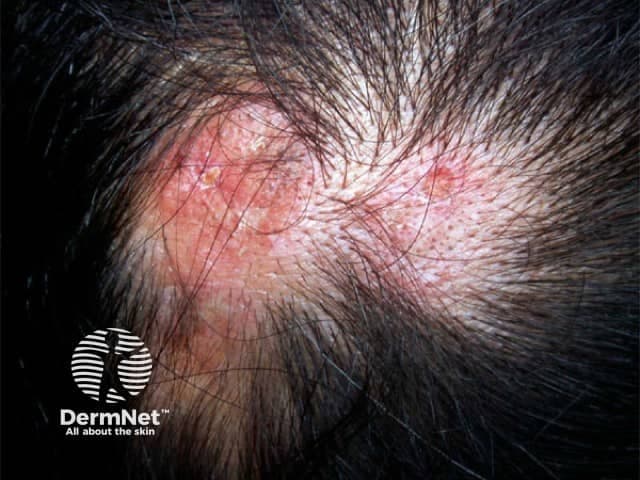 Clinical photography of a scalp lesion demonstrates classic discoid lupus erythematosus (DLE) features. The image shows well-demarcated, erythematous to violaceous plaques with adherent scale, follicular plugging, and central atrophy within the hair-bearing scalp. Hair loss is patchy and the affected areas may progress to irreversible scarring alopecia. The margins are often raised and inflammatory, with surrounding pigmentary changes that may include hyperpigmentation or hypopigmentation depending on skin phototype. These cutaneous plaques are typically sun-exposed site–predilection lesions and may appear in chronic, fluctuating courses. Clinically, DLE must be distinguished from seborrheic dermatitis, tinea capitis, lichen planopilaris, and psoriasis; biopsy or dermoscopy can aid in confirmation. If biopsy is performed, histology reveals interface dermatitis with basal layer vacuolization, thickened basement membrane, perivascular and periadnexal lymphocytic infiltrate, and follicular plugging; mucin deposition may be present. Management involves photoprotection, topical or intralesional corticosteroids for active plaques, and systemic agents such as antimalarials in extending disease, with caution for systemic lupus erythematosus. This image is valuable for dermatology education, lesion recognition, differential diagnosis training, and AI-enabled image retrieval for cutaneous lupus and scarring alopecia research. Keywords: discoid lupus erythematosus, DLE, scalp lesions, scarring alopecia, autoimmune skin disease, hair loss. Clinical relevance includes guiding biopsy decisions and treatment planning.