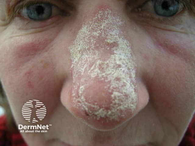 A high resolution clinical photograph documents localized cutaneous discoid lupus erythematosus of sun exposed facial skin, notably the nasal dorsum and surrounding perinasal cheeks. The frontal, close up view shows well demarcated erythematous plaques with adherent whitish scale and crusting, surface desquamation, and subtle follicular plugging. Lesions appear on the nasal bridge with partial peripheral involvement, displaying an atrophic center and peripheral erythema; mild telangiectasia may be evident in chronically sun exposed areas. This morphologic pattern—oval or polygonal plaques with silvery scale and scarring tendency—aligns with classic discoid lupus as a chronic inflammatory dermatosis within the spectrum of cutaneous lupus erythematosus. Although biopsy is not provided here, typical histopathology would reveal epidermal atrophy, interface dermatitis, follicular plugging, dermal lymphocytic infiltrates, and increased dermal mucin if sampled. Clinically, the image underscores the risk of pigmentary change and scarring on the nose with ongoing disease activity. Relevance to practice includes differentiating discoid lupus from seborrheic dermatitis, rosacea, psoriasis, or actinic keratosis in sun exposed facial zones. Management implications involve sun avoidance, topical anti inflammatory therapies, calcineurin inhibitors, and consideration of systemic antimalarials for disease control, with regular monitoring for evolution or systemic involvement. This image is educational for clinicians, students, and researchers.