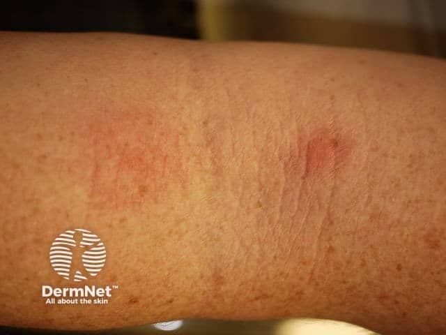 This is a high‑resolution clinical photograph of in vivo human forearm skin documenting an erythematous, patchy rash. Modality: Clinical photography, non‑dermoscopic; close‑up view of the antebrachial skin. Anatomical location: Forearm, integumentary system, with involvement of the superficial epidermis and dermis. Visual features: diffuse erythema with ill‑defined, slightly raised patches, mild desquamation along margins, subtle perifollicular accentuation, and no obvious vesicles or crusts. Skin texture shows mild edema and minimal hyperpigmentation beyond the red areas. The lesion spans a proximal to distal segment of the forearm and exhibits a non‑focal distribution on the extensor surface. Possible etiologies include inflammatory dermatitis such as irritant or allergic contact dermatitis, atopic dermatitis (eczema), or other eczematous processes. Differential diagnosis also includes early psoriasis or drug eruption; however, absence of well‑formed plaques or silvery scale argues against classic plaque psoriasis, and lack of vesicular lesions makes bullous diseases unlikely. Notable significance: image documents a cutaneous inflammatory process and serves as educational dermatology material, triage aid in primary care, and baseline for monitoring therapy response. Clinical utility: baseline documentation, serial assessment of lesion evolution, correlation with environmental exposures, and guiding patch testing and patient counseling. Further documentation may include dermoscopy or biopsy if persistence occurs unexpectedly.