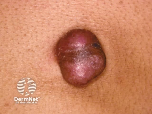 Clinical skin lesion photograph showing a solitary, dome-shaped cutaneous nodule with a smooth, glossy surface and a reddish-purple hue. The lesion sits within normal skin and appears firm, with minimal surface change and no overt ulceration in this frontal close-up view. The image captures a typical presentation of a slowly enlarging dermal/subcutaneous mass on the trunk or proximal limbs, where dermatofibrosarcoma protuberans (DFSP) commonly arises. DFSP characteristically presents as a firm plaque that evolves into a protuberant nodule; color ranges from skin-colored to violaceous. Although a single photograph cannot confirm histology, this lesion warrants biopsy given its clinical behavior and color, to differentiate DFSP from benign mimickers such as dermatofibroma, keloid, and fibrous histiocytoma. Histopathology (on biopsy) would reveal a storiform/spindle-cell proliferation with infiltration into subcutaneous fat (honeycomb pattern) and typically CD34 positivity. Clinically, DFSP is locally aggressive with a high risk of recurrence if margins are inadequate; treatment is wide local excision or Mohs micrographic surgery with clear margins and appropriate follow-up. This image is relevant for dermatology education, biopsy decision-making, differential diagnosis practice, and correlating clinical appearance with subsequent histopathology and treatment planning. Early diagnostic biopsy improves prognosis by guiding definitive surgical planning and surveillance for recurrence.