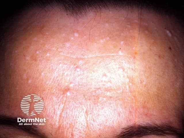 Clinical photograph of facial skin (dermatology) showing multiple fibrofolliculomas on the forehead. This frontal close-up capture highlights numerous small, dome-shaped, skin-colored papules arranged in a diffuse distribution over the frontal region and upper cheeks. The lesions are firm to touch, non-tender, and primarily atop pilosebaceous units with perifollicular accentuation. The overlying epidermis appears intact with minimal erythema; there is no evident ulceration or crusting. In life, such lesions are benign adnexal neoplasms composed of epithelial strands arising from hair follicles within a fibrous stroma; histology typically reveals anastomosing cords of basaloid cells embedded in a fibrous matrix, often with horn cysts. Clinically, the presence of multiple fibrofolliculomas, especially in conjunction with other facial papules, may suggest Birt-Hogg-Dubé syndrome, mandating assessment for renal imaging and pulmonary cysts and familial counseling. Differential considerations include trichofolliculoma, perifollicular fibroma, sebaceous hyperplasia, and milia. This image is valuable for dermatology education, clinic documentation, cosmetic planning, and teaching differential diagnosis of follicular papules. It supports correlation with genetic testing and multidisciplinary management when systemic associations are suspected. Useful for medical students, residents, and fellows refining pattern recognition of facial adnexal tumors. This description emphasizes clinical morphology, correlates with histology, and supports educational annotation for imaging repositories.