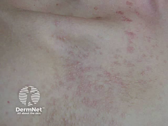 Clinical photograph (DermNet watermark) of the skin showing multiple small follicular papules with mild erythema. The image depicts a close-up, macro view of the integumentary surface, suitable for dermatologic morphology assessment. Primary subject: fibrofolliculomas, benign hair-follicle–origin hamartomas often appearing as dome-shaped, flesh-colored papules; in some individuals they may appear erythematous or coalescent in plaques. Here, the lesions are discrete to slightly grouped, with perifollicular localization and a surface that is smooth or gently papular. The distribution is trunk/torso region with no obvious mucosal involvement; there is no scale, crust, or central keratin plug evident in this frame. The image emphasizes follicular localization, hinting at adnexal origin. The technique is noninvasive clinical photography with standard lighting; no contrast or staining is used. This depiction is intended for documentation, pattern recognition, and differential diagnosis of follicular tumors in dermatology. Diagnostic significance: when multiple fibrofolliculomas are present, consider inherited syndromes such as Birt-Hogg-Dubé; correlate with patient history, lung imaging, renal surveillance. Differential includes trichofolliculoma, sebaceous hyperplasia, syringoma, trichoepithelioma, and other adnexal tumors. Clinical correlation and, if indicated, histopathology confirm diagnosis. Clinical utility includes educational use for students and trainees, aiding pattern recognition, differential narrowing, and patient counseling about benign prognosis and potential systemic associations.