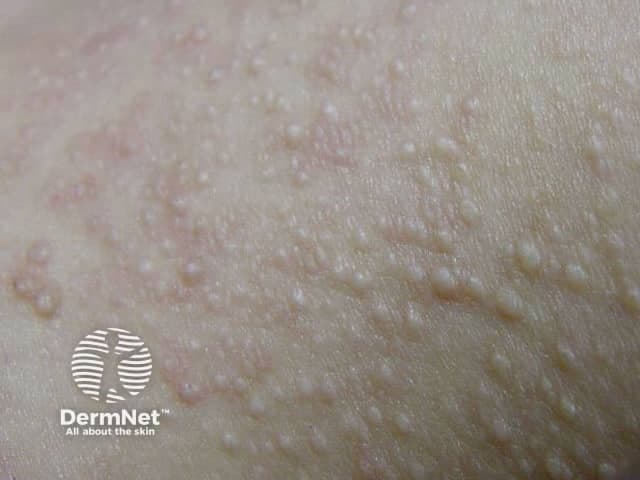 This is a dermatology clinical photograph showing multiple small, dermal papules on the facial skin, particularly on the cheeks and perioral region. The lesions are 1–3 mm, dome-shaped, skin-colored to slightly pale, with a smooth surface and firm consistency. Perifollicular localization is evident, with subtle shading around each papule reflecting superficial dermal involvement. The photo is a close-up macro view, suitable for documenting cutaneous follicular lesions. The pattern is often bilateral and symmetrical and may extend to the neck or trunk in some cases. These lesions are characteristic of fibrofolliculomas, benign hamartomas of facial hair follicles. If numerous or associated with renal tumors or pulmonary cysts, consider Birt-Hogg-Dubé syndrome. Differential diagnosis includes milia, syringomas, sebaceous hyperplasia, trichoepithelioma, and folliculitis. Clinically, the presence of multiple lesions warrants assessment for systemic associations and family history. In practice, management includes observation for cosmetic concerns, laser or surgical removal for selected lesions, and genetic counseling if a hereditary syndrome is suspected. For diagnostic confirmation, dermatopathology can reveal the classic epithelial strands in fibrous stroma. Imaging-wise, this photo supports a dermatology diagnosis and should be correlated with patient history and potential renal/pulmonary imaging if there is systemic suspicion. Consult dermatology and genetics teams for evaluation.