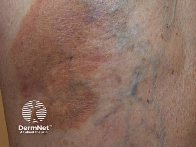 This is a high-resolution clinical photograph of a skin fragment consistent with lichen aureus, a localized variant of the pigmented purpuric dermatoses spectrum. Modality: clinical photography of the skin; view: close‑up, surface appearance of the lower leg region (pretibial area) with oblique perspective. The image demonstrates a well‑defined, rust‑orange to golden‑brown patch, often described as lichenoid or patch‑like, with subtle violaceous remodeling at the periphery. Surface texture is largely flat with minimal scale; there are no erosions or vesicles. Within the patch, faint peppering or punctate purpura may be suggested, compatible with superficial capillaritis and red blood cell extravasation. The lesion appears non-tender and asymptomatic or mildly pruritic, and there is no evidence of systemic illness in this image. These features support a clinical diagnosis of lichen aureus, typically a solitary or few lesions confined to the lower extremities and persisting for weeks to months. Pathophysiology involves capillary inflammation with hemosiderin deposition, producing the characteristic color. Diagnostic significance lies in distinguishing pigmented purpuric dermatoses from vasculitis or inflammatory dermatitis; biopsy is reserved for atypical cases. Clinical utility includes education, differential diagnosis practice, and guiding conservative management with topical steroids or observation, and vascular risk assessment if indicated.
